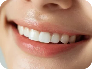 沖縄県で唯一ボーテ式ホワイトニング